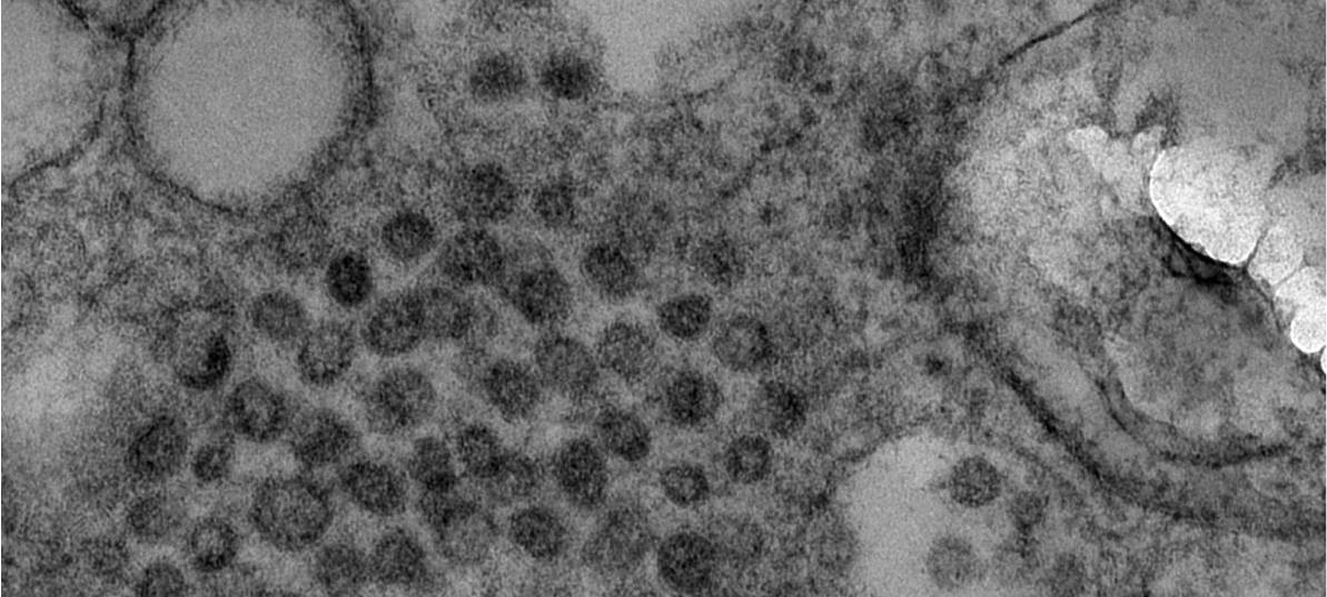 RWTH-Forscher: Covid kann Nieren schädigen