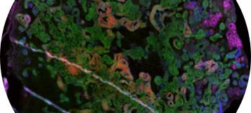 RWTH-Forscher: Covid kann Nieren schädigen